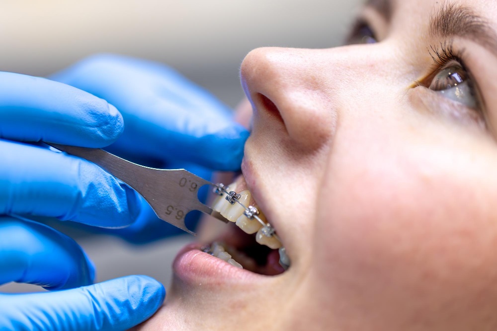 Ortodonzia linguale: la soluzione discreta per allineare i denti