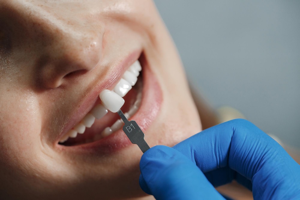 Cosa sono le faccette estetiche dentali e quando metterle