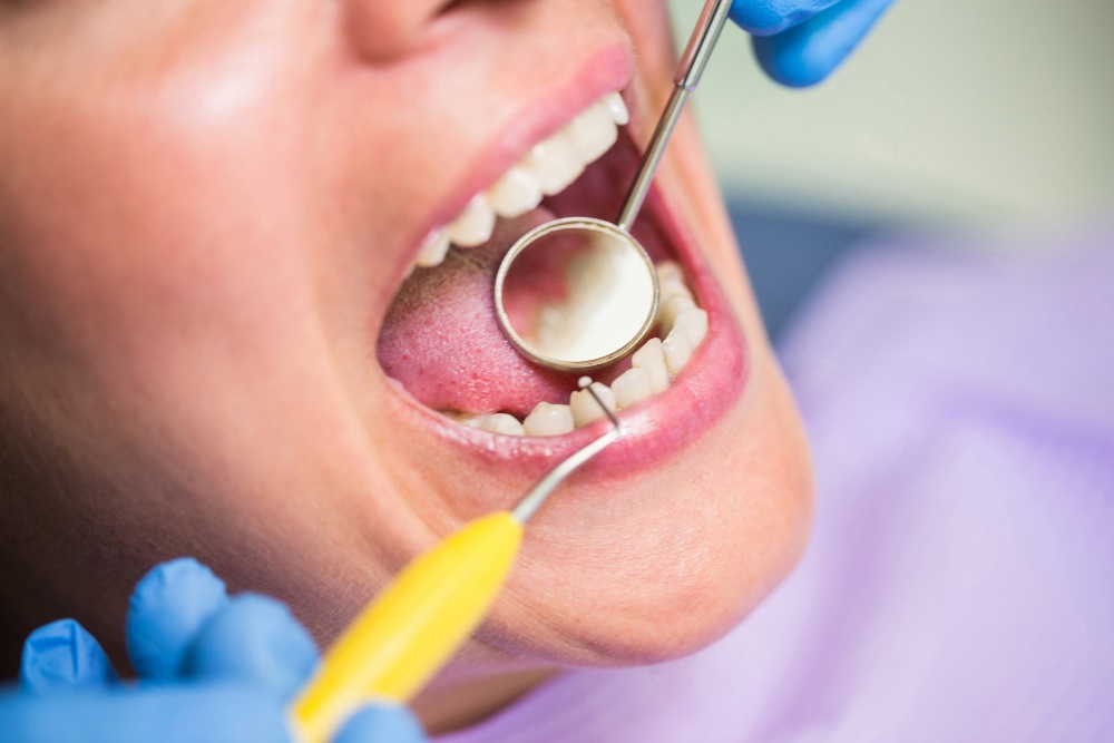Le tipologie e gli stadi delle carie dentali